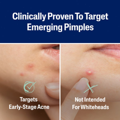 Cetaphil Acne Spot Pimple Patches with Salicylic Acid - 24ctâ